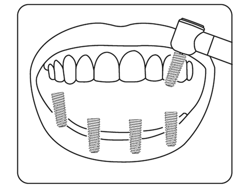Surgical guide